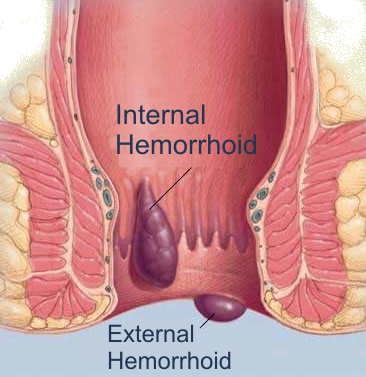 Hemorrhoids__Causes__Complications___Treatment_PADYPADY_STORY_8754